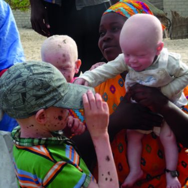 Albino kinderen