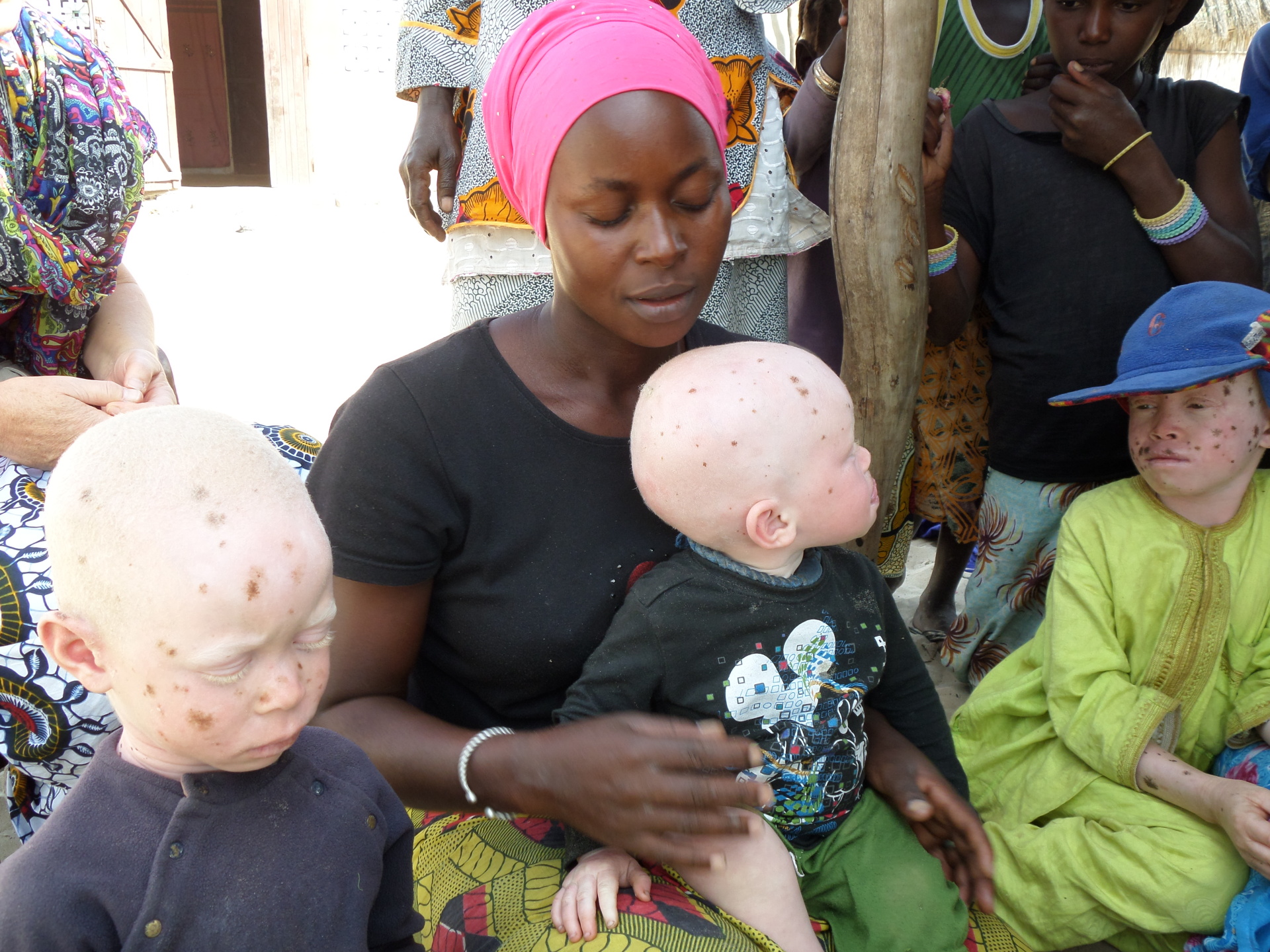 Sun hats for albino children